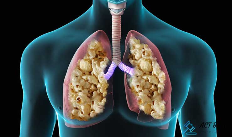 What You Need to Know about Popcorn Lung Lawsuit