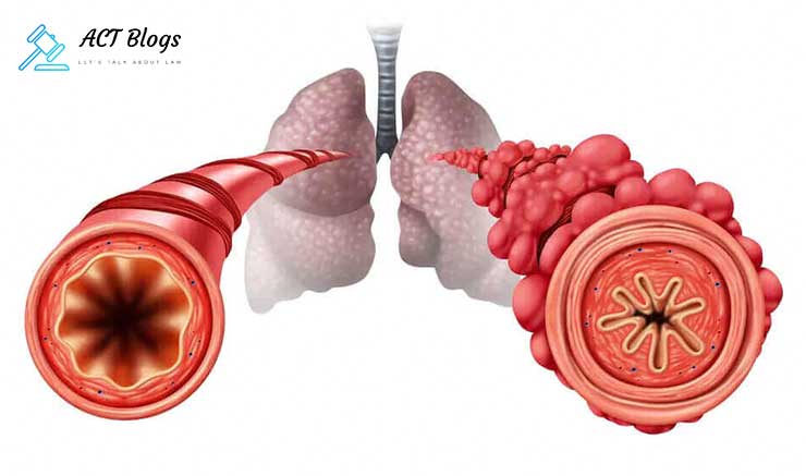 4 Tips to Help You Get a Fair Compensation for Popcorn Lung