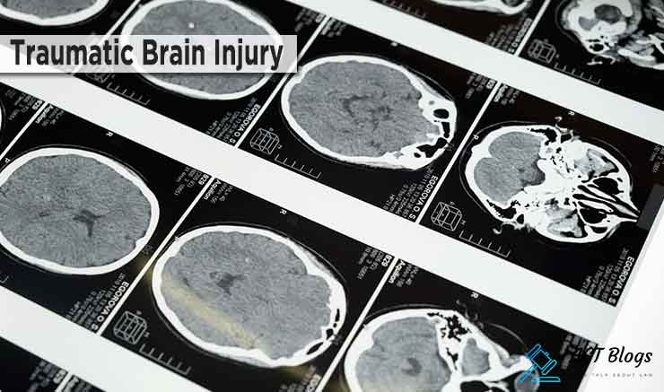 What Types of Compensation Can You Receive for a Traumatic Brain Injury
